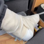 アキレス腱断裂の写真