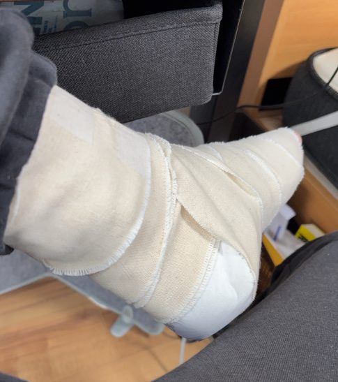 アキレス腱断裂の写真